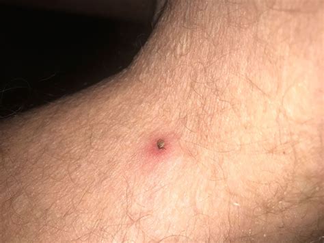 Tick bites! What are the risks, how to avoid them, and what to do if ...