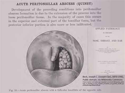 Peritonsillar Abscess Management | Iowa Head and Neck Protocols