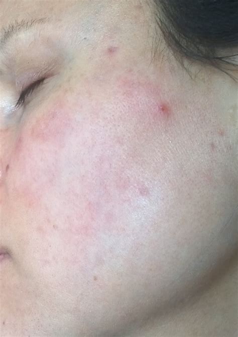 healthyself: Bu Zhong Yi Qi Tang and MRSA