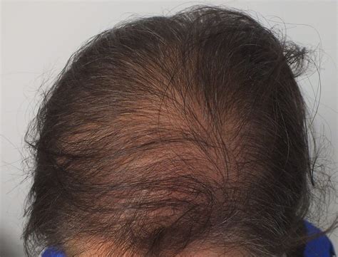 Hair Transplant For Women | Doç.Dr. Ekrem Civas - Ankara