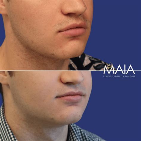 washington dc facelift surgery    pictures tysons corner