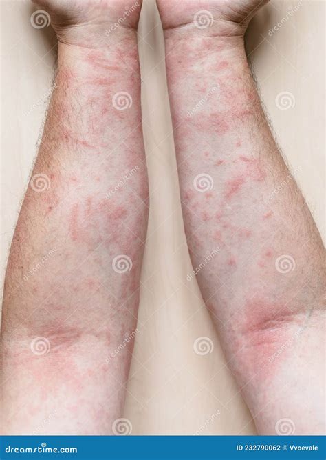 Itchy Rash On Arms Legs And Trunk at Justin Finn blog