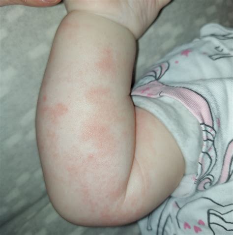 We Couldn't Find Childcare that Could Keep my Allergic Daughter Safe