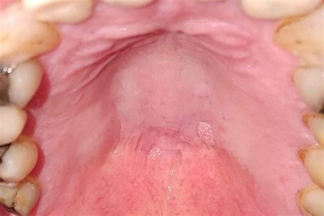 Tonsil Cancer Early Signs