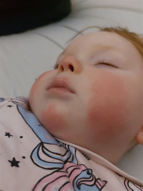 We Couldn't Find Childcare that Could Keep my Allergic Daughter Safe