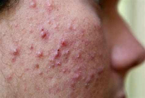 Золотистый Стафилококк На Голове Фото – Telegraph