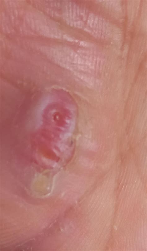 Painful lump : r/pimplecommunity