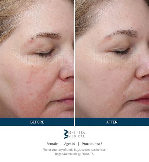 microneedling front range dermatology
