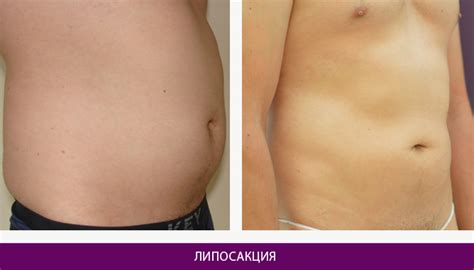 Липосакция в Киеве. Цена на липосакцию живота.