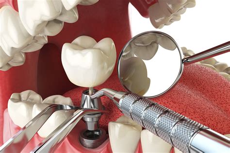 Dental Implants for Molar Replacement