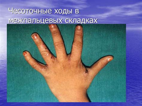 Чесотка. Пиодермиты. Организация борьбы с пиодермитами. Роль санитарных ...