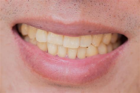 Yellow Teeth Pictures | Download Free Images on Unsplash