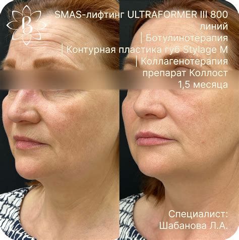 До и после контурной пластики - фото | клиника «Красивые люди» в Петербурге