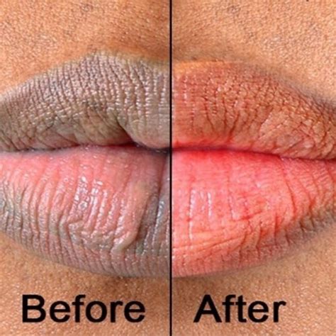 laser lip depigmentation turkish private clinics