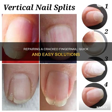 how to fix a cracked finger nail
