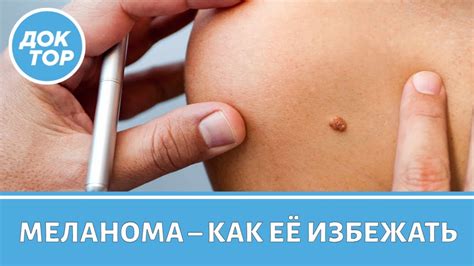 Как избежать меланомы и как ее вовремя обнаружить - YouTube