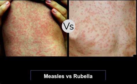 Rubella Rash Vs Measles Rash