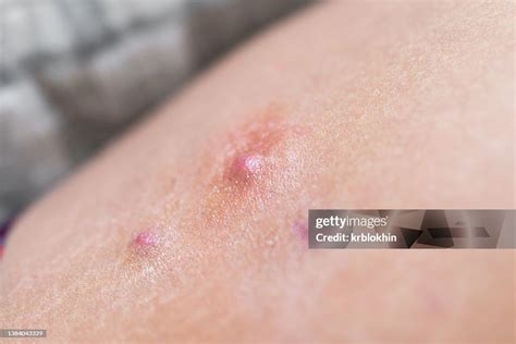 Macro Closeup Of Red Swollen Boil Pimple On Leg Skin Of Female Woman ...