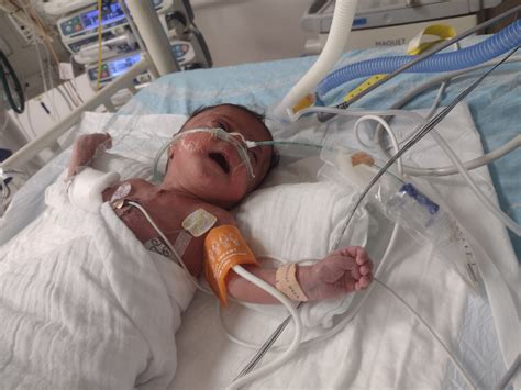 intubated