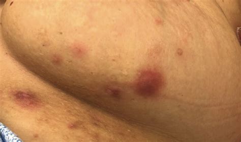 hidradenitis suppurativa focus  diagnosis