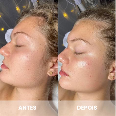 Dermaplaning Para Que Serve - Para que serve o Dermaplaning? Especialista explica tudo