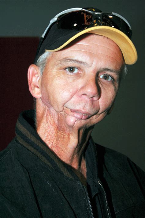 Chewing Tobacco Mouth Cancer Images at Carrie Alston blog