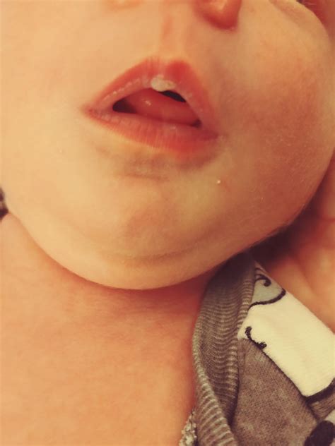 Milk Blister Baby Lip