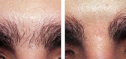 Laser Hair Removal · Laser Advantage