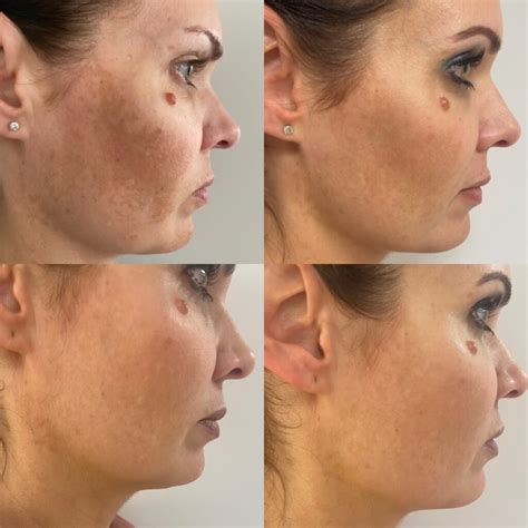 Before and After: What to Expect from a BBL Treatment at Ageless ...