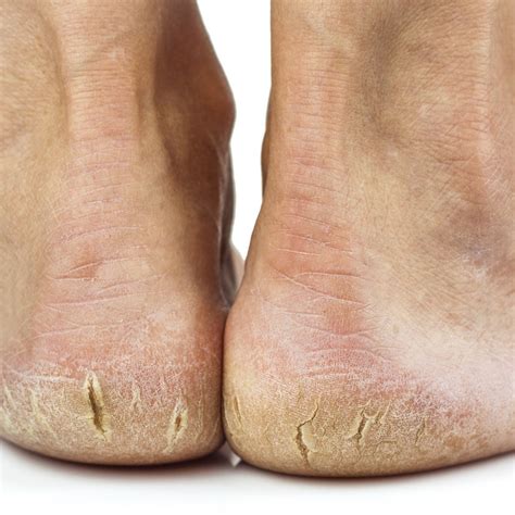 cracked heels kensington podiatry