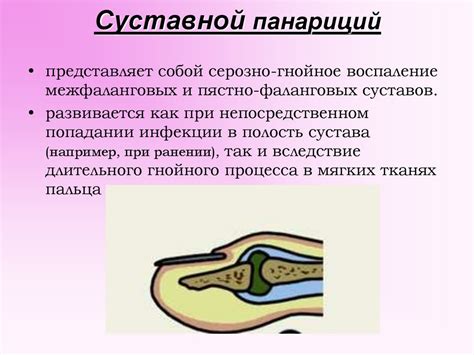 Панариций на пальце руки: что это такое, симптомы, как быстро вылечить ...