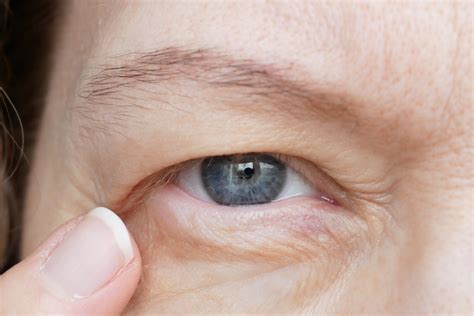 how to fix a droopy eyelid without surgery