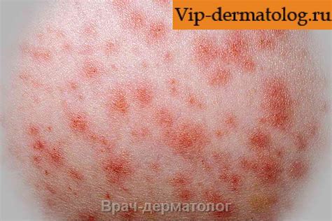 Узловатая эритема фото. Как выглядит узловатая эритема на фото у детей ...