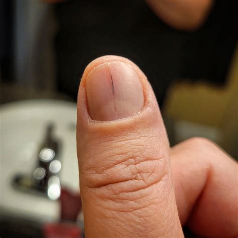Subungual Melanoma. : r/Melanoma