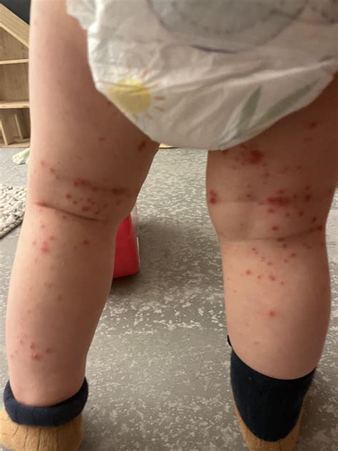 Two doctors couldn’t identify this rash : r/DermatologyQuestions