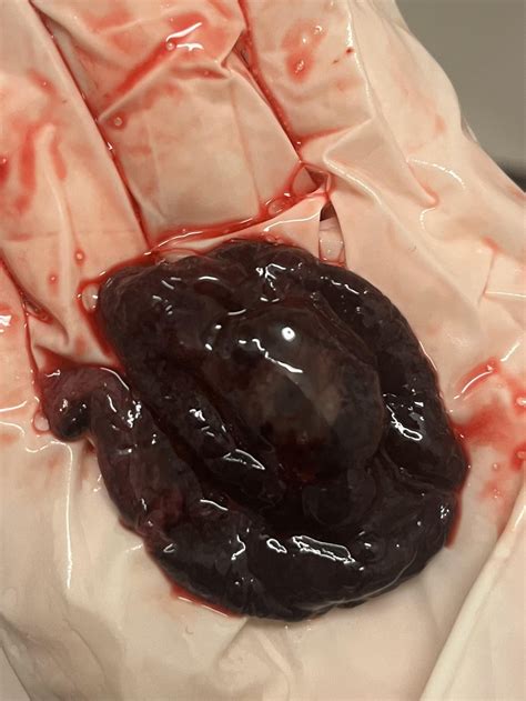 6 week miscarriage images 1