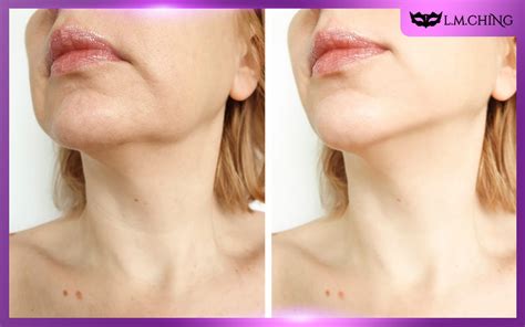 [Review] Medi Peel Naite Thread Neck Cream (Naite Thread Neck Cream 10 ...