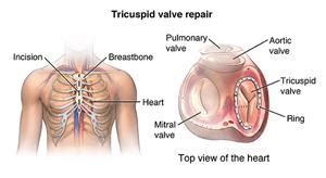 Tricuspid Valve Repair Surgery - Stanford Medicine Children's Health