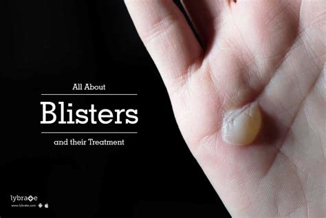 blisters   treatment  dr umesh alegaonkar lybrate