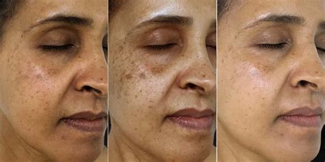 Why Do Dark Spots Get Darker Before They Get Lighter? – Vivant Skin Care