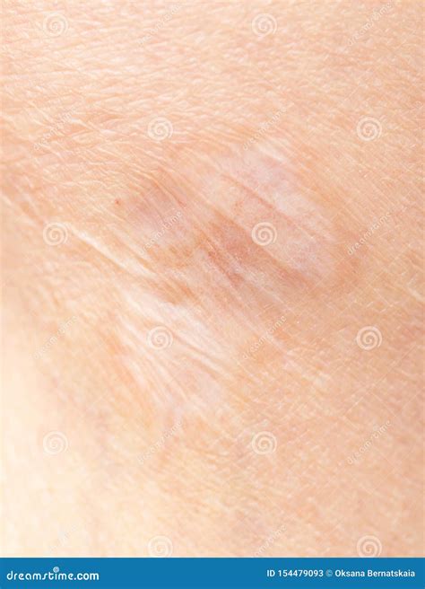 Scar on the Skin of a Female Leg Stock Image - Image of background ...