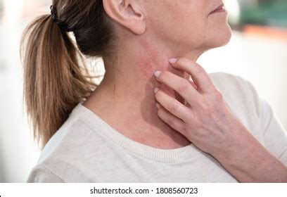 Allergic Reaction Rash On Neck