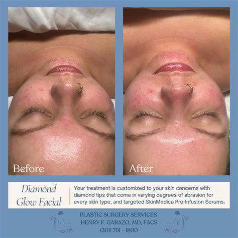 DiamondGlow | Hagerstown Plastic Surgery Services | Dr. Garazo