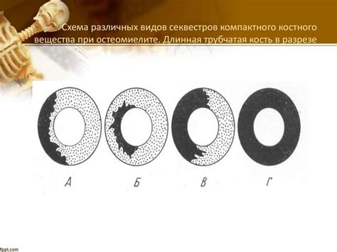 Рентгенодиагностика остеомиелита - презентация онлайн