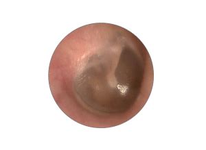 Clinical Examination of The Ear