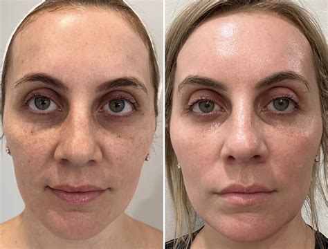 The Complete Guide To Laser Skin Resurfacing - Coastal Aesthetics