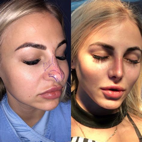 Rhinoplasty Surgery, Nose Surgery, Facial Fillers, Celebrity Plastic