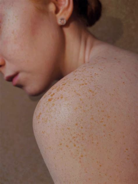 Hard Water Rash: Can Hard Water Cause Skin Irritation? - DROP