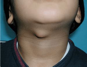 Caroço No Pescoço De Criança O Que Pode Ser - Um caroço no pescoço | Cirurgia Pediátrica