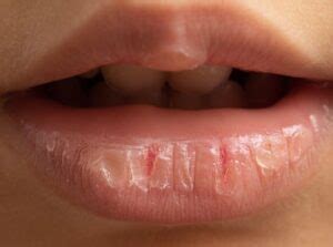 Watery Bowel Movements In Children | Causes And Treatment